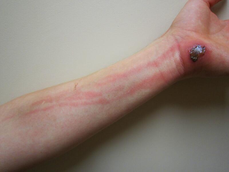 Lymphangitis: Symptoms, Causes, Treatment, and More