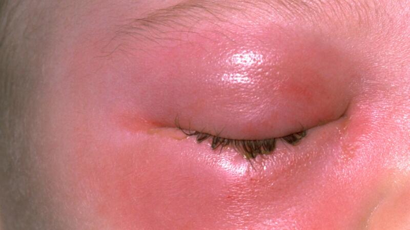 Periorbital Cellulitis Causes Symptoms And Treatment periorbital-cellulitis-causes-symptoms-and-treatment