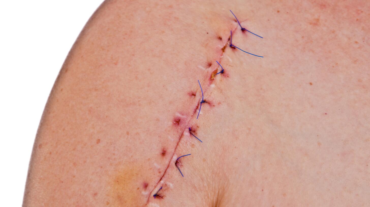Dissolvable Stitches 7 SelfCare Tips