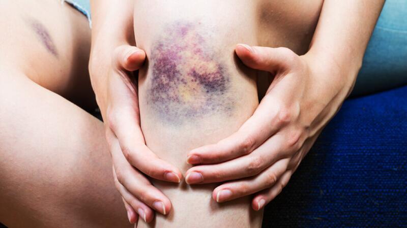 Person with large bruise on knee, a symptom of liver cirrhosis. Cirrhosis is a risk factor of esophageal varices.