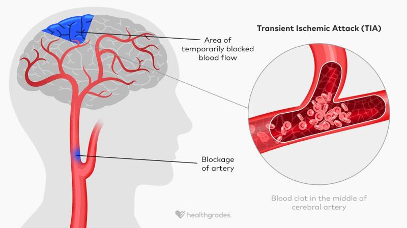 TIA Strokes: Symptoms, Treatments, and Prevention