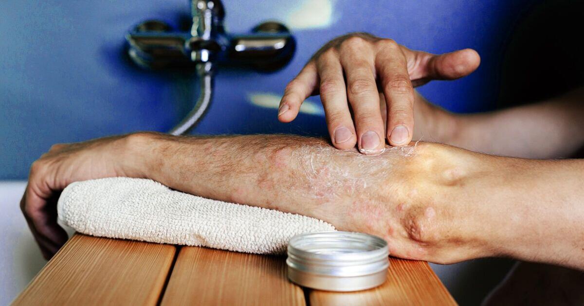 Ulcerative Colitis Rashes: Skin Conditions, Symptoms, Treatment