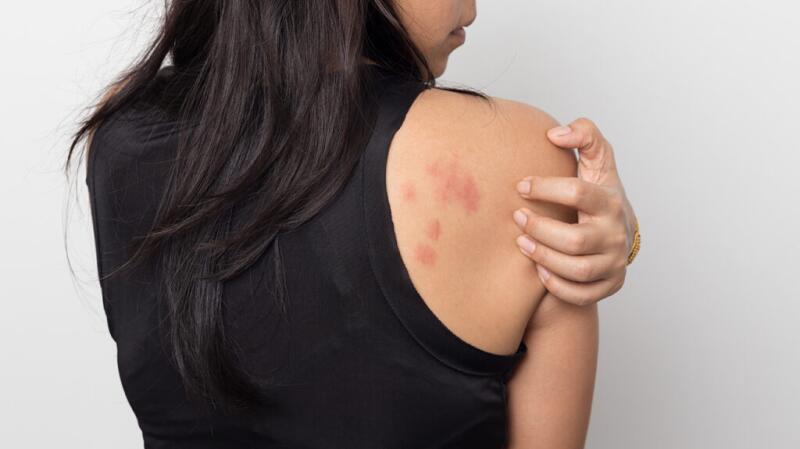woman showing her skin itching behind , with allergy rash urticaria symptoms
