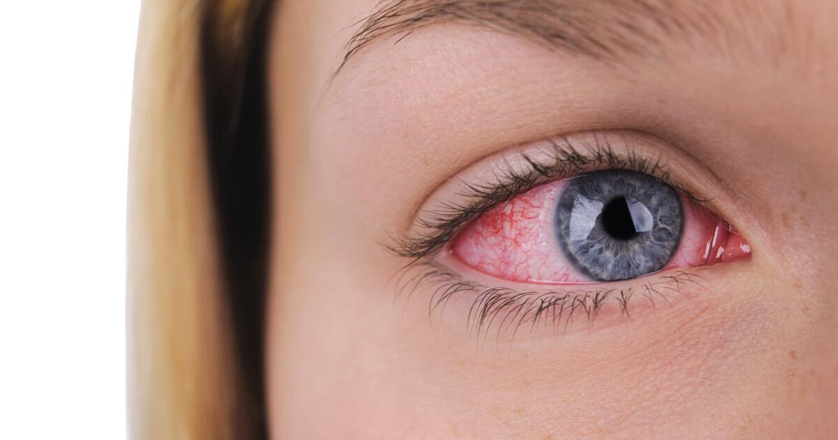 Eye Herpes Symptoms Causes Treatments Eye Herpes Symptoms Causes Treatments