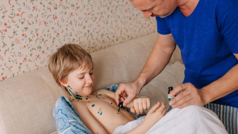 A parent applies ointment to a child's chickenpox spots.