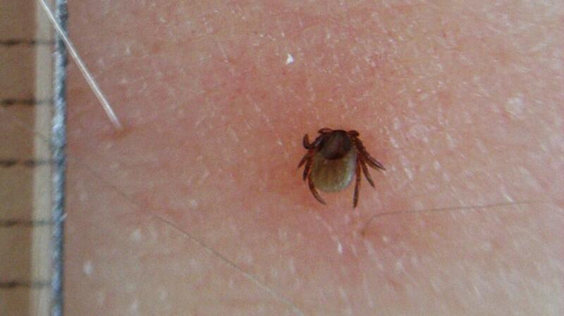 Close-up image of tick bite with tick embedded in human skin