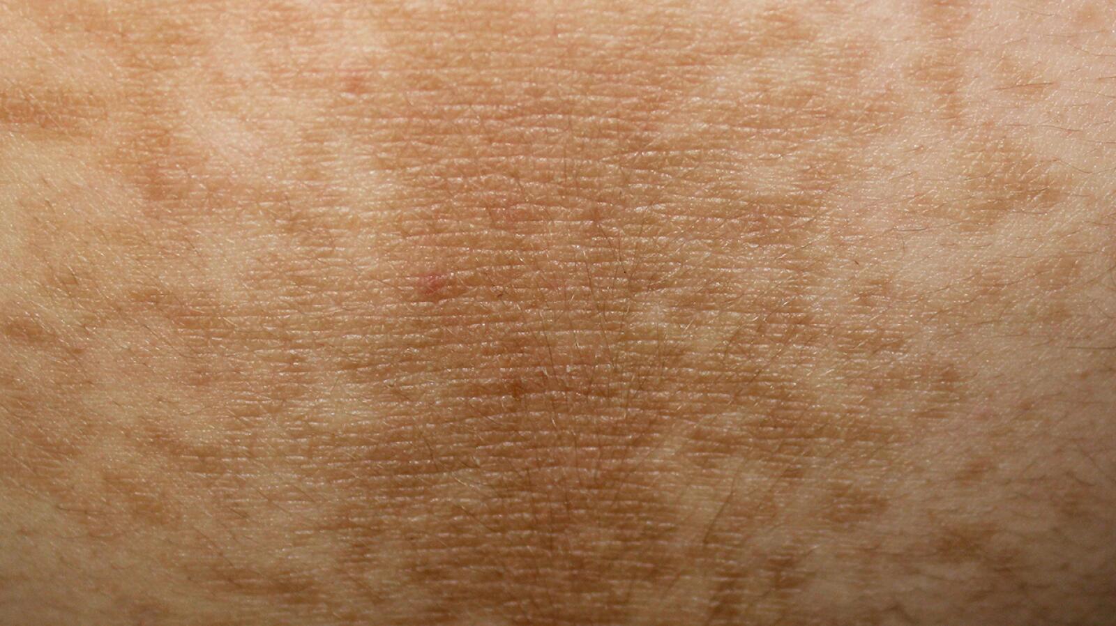 Acanthosis Nigricans Appearance Causes And Treatment