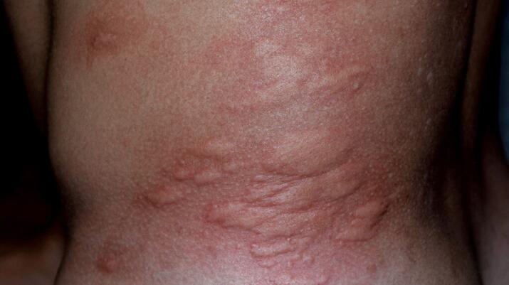Allergy skin back and sides.  Allergic reactions on the skin in the form of swelling and redness