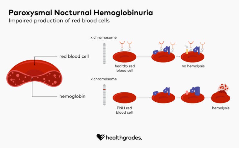 Paroxysmal Nocturnal Hemoglobinuria: What You Need Know
