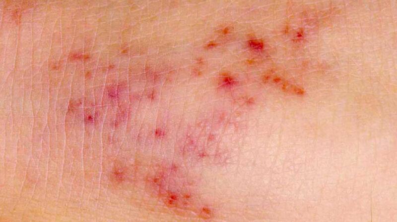 Red Spots on Skin - HubPages