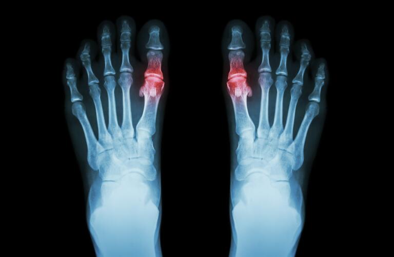 x ray of feet showing gout