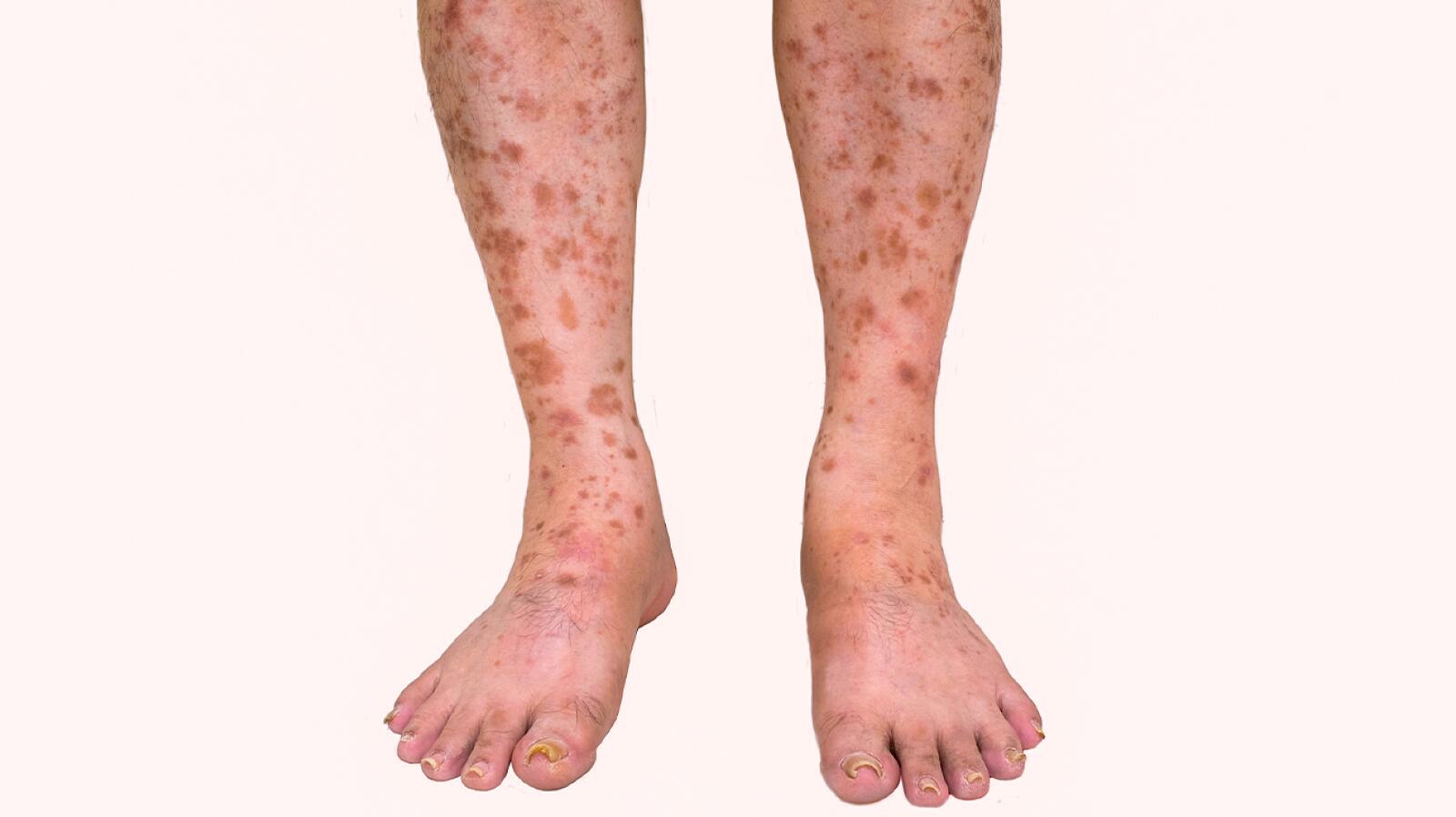 Rash On Legs Causes And Treatment 