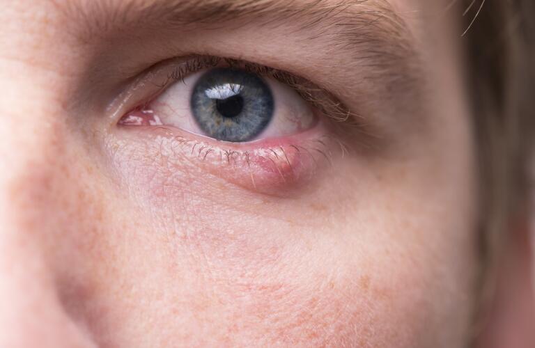 Close up male's face with infected lower eyelid