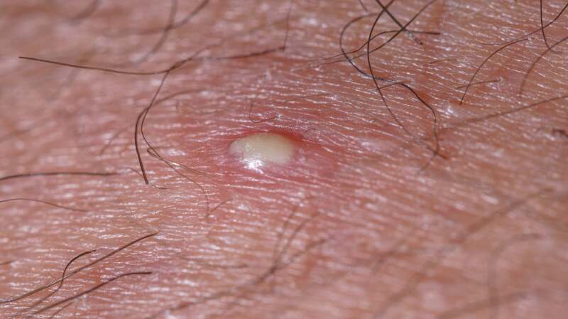 What Is Pus? Causes, Treatment, and More Explained
