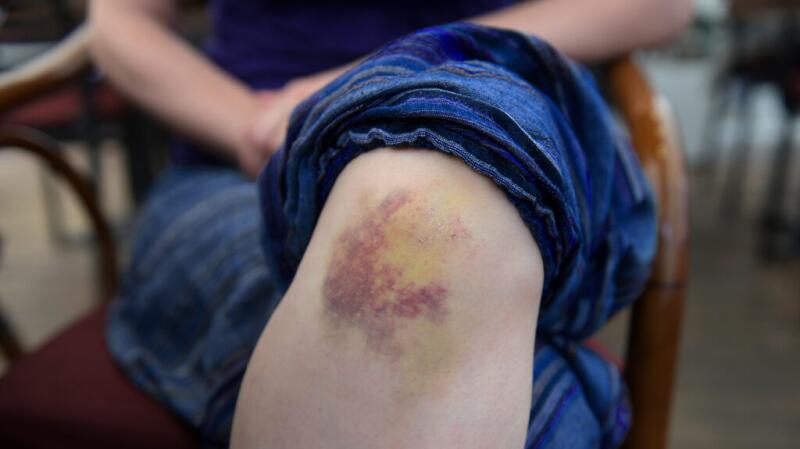 A bruised knee