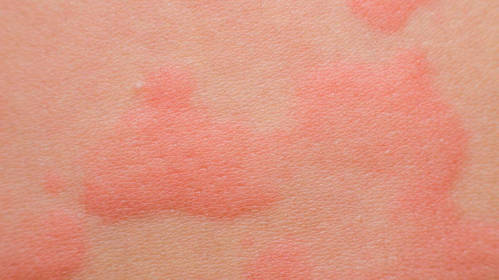 Cold Urticaria: Symptoms, Causes, and Treatment