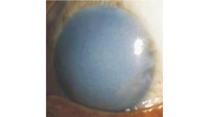 A close-up of an eye with a cloudy cornea