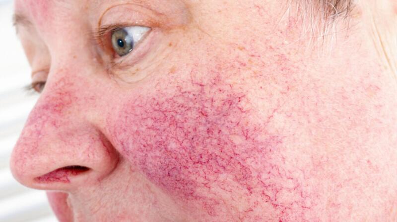 A close-up photo of a woman with erythematotelangiectatic rosacea on her face