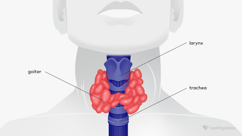 Enlarged Thyroid: Causes, Symptoms, and Treatment of Goiter