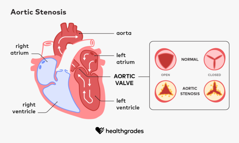 Aortic Stenosis - Progression, Outlook, Symptoms, and Treatments