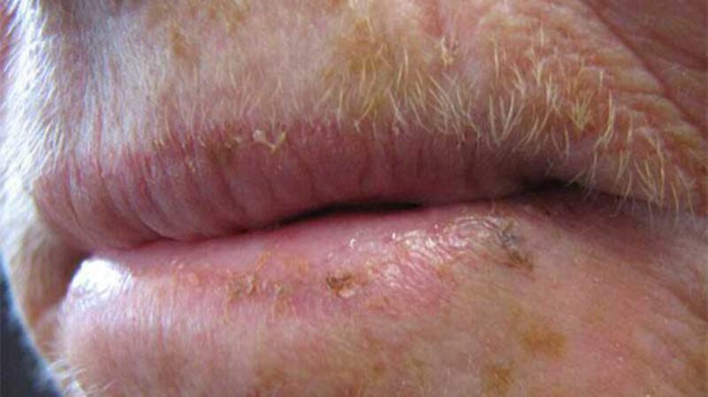 Crusting actinic chelitis lesions on lips.