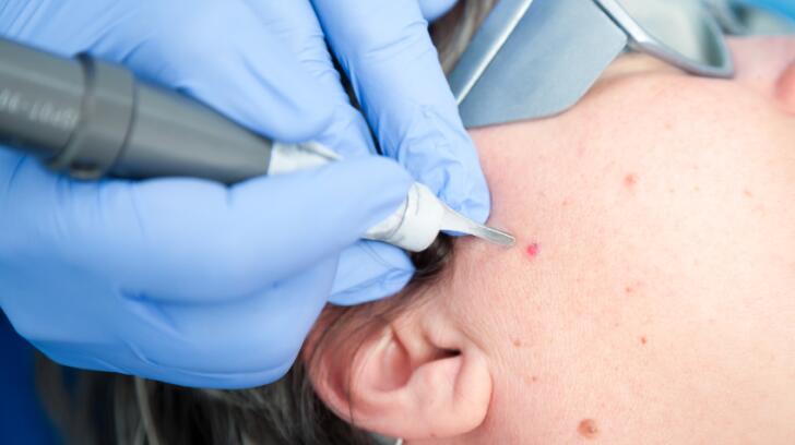 Mohs surgery