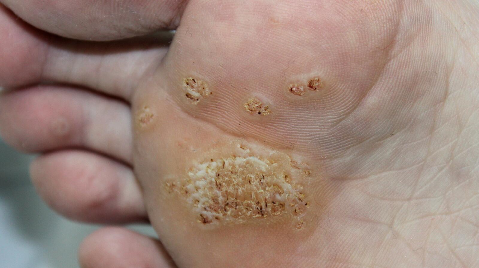 Warts Symptoms Causes Removal And More warts-symptoms-causes-removal-and-more