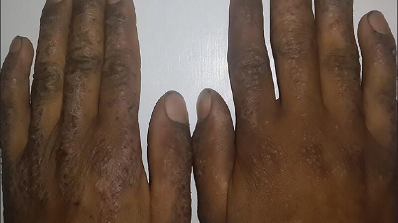 Rash on Hands: Symptoms, Treatments, Causes, and More