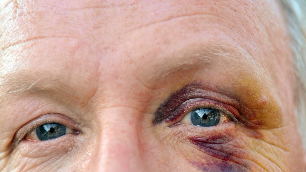 Black Eye Recovery | How Long It Takes A Black Eye To Heal