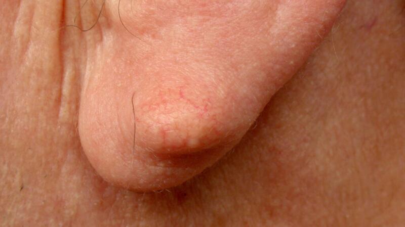 sebaceous cysts behind ear