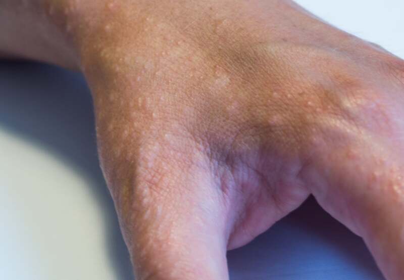 A medical image of dyshidrotic eczema.