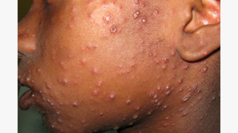 dark skinned child with chickenpox blisters on face