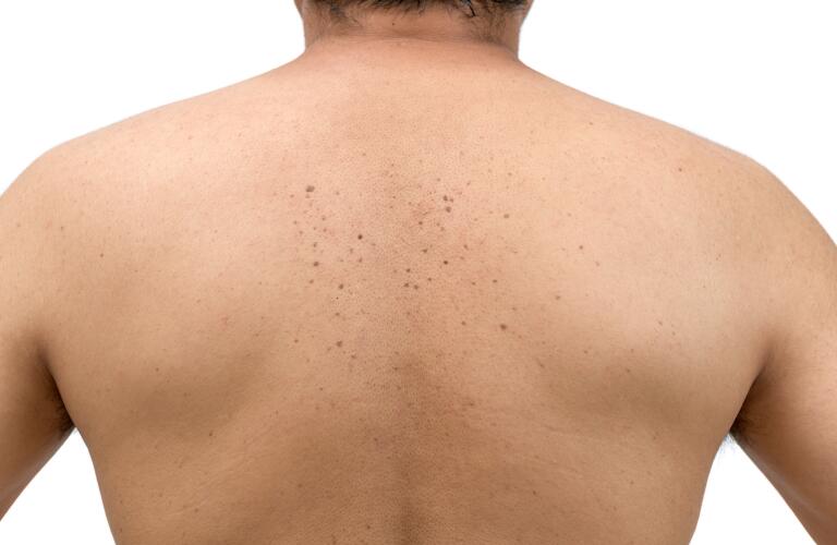 skin tags or seborrheic keratosis on man's back