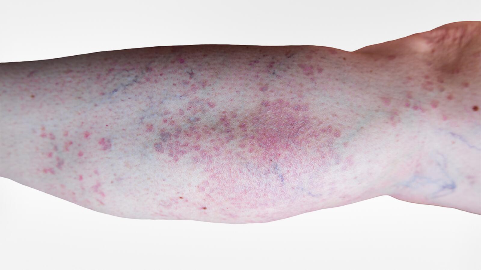 Granular Rash Granuloma Annulare: Symptoms, Causes, Diagnosis, and Treatments