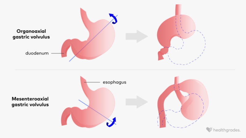 illustration of gastric volvulus, a rare condition where the stomach rotates abnormally more than 180 degrees