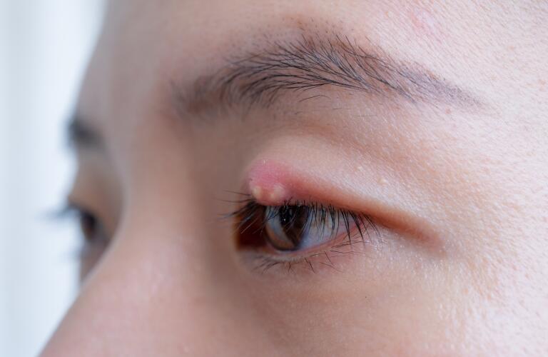 Close up of young woman with eyelid abscess