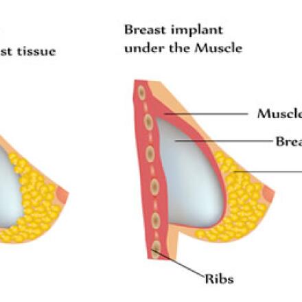 Get a detailed description of breast augmentation so you can set realistic expectations.