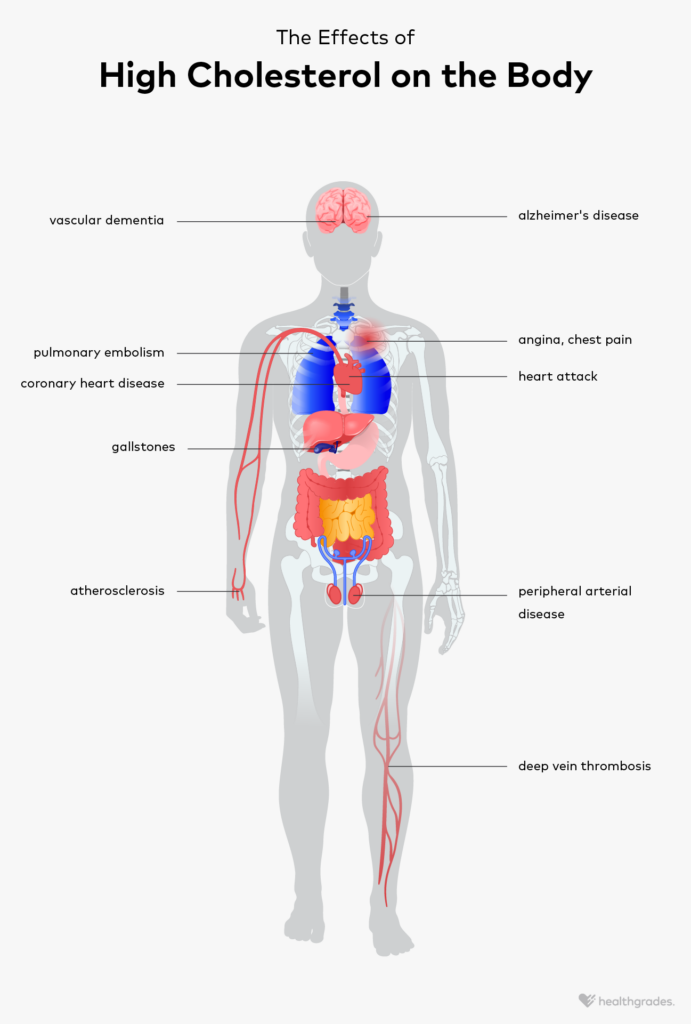 What Are the Risks of High Cholesterol? Effects and Prevention
