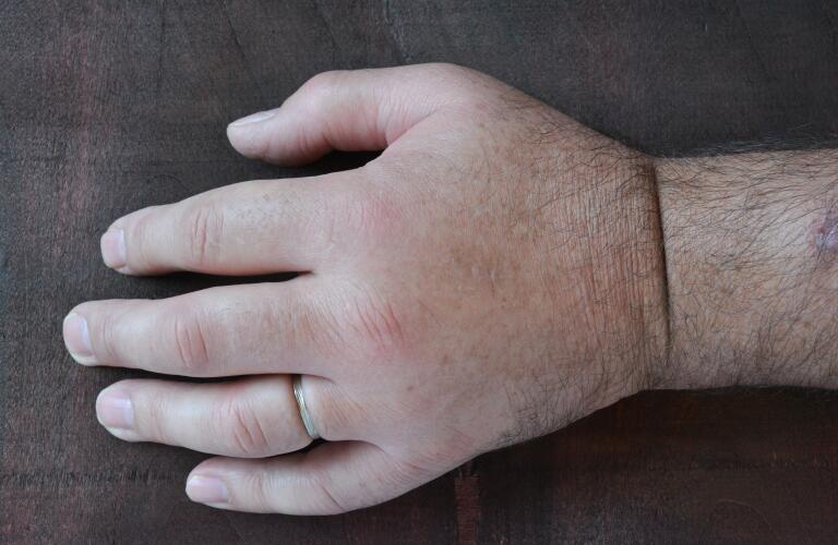 Swollen fist due to edema or allergic reaction