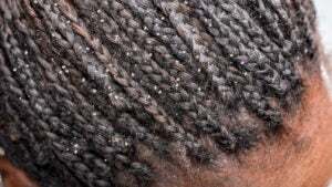 Skin Dander Seborrheic Dermatitis vs. Dandruff: Symptoms and Treatments