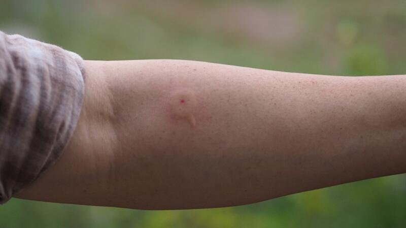 Red Wasp Sting Swelling red-wasp-sting-swelling