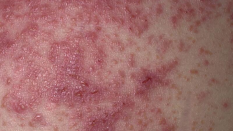 Hazelnut Rash Dermatitis Herpetiformis (Gluten Rash): Everything to Know