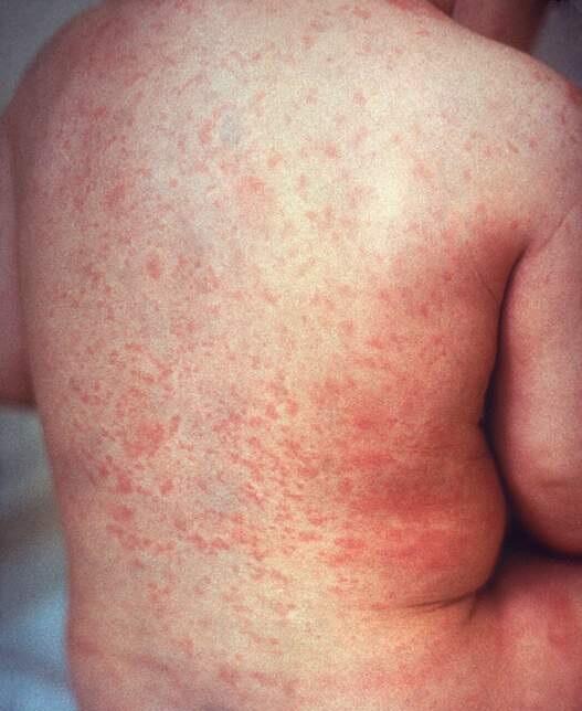 Rash on Back: Causes Treatments, Symptoms, and More