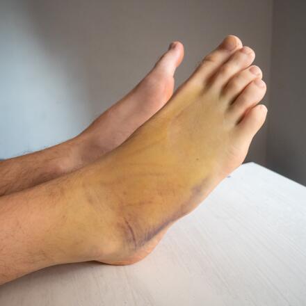 A bruise on your foot doesn't mean it's broken. Find out what other symptoms to look for.