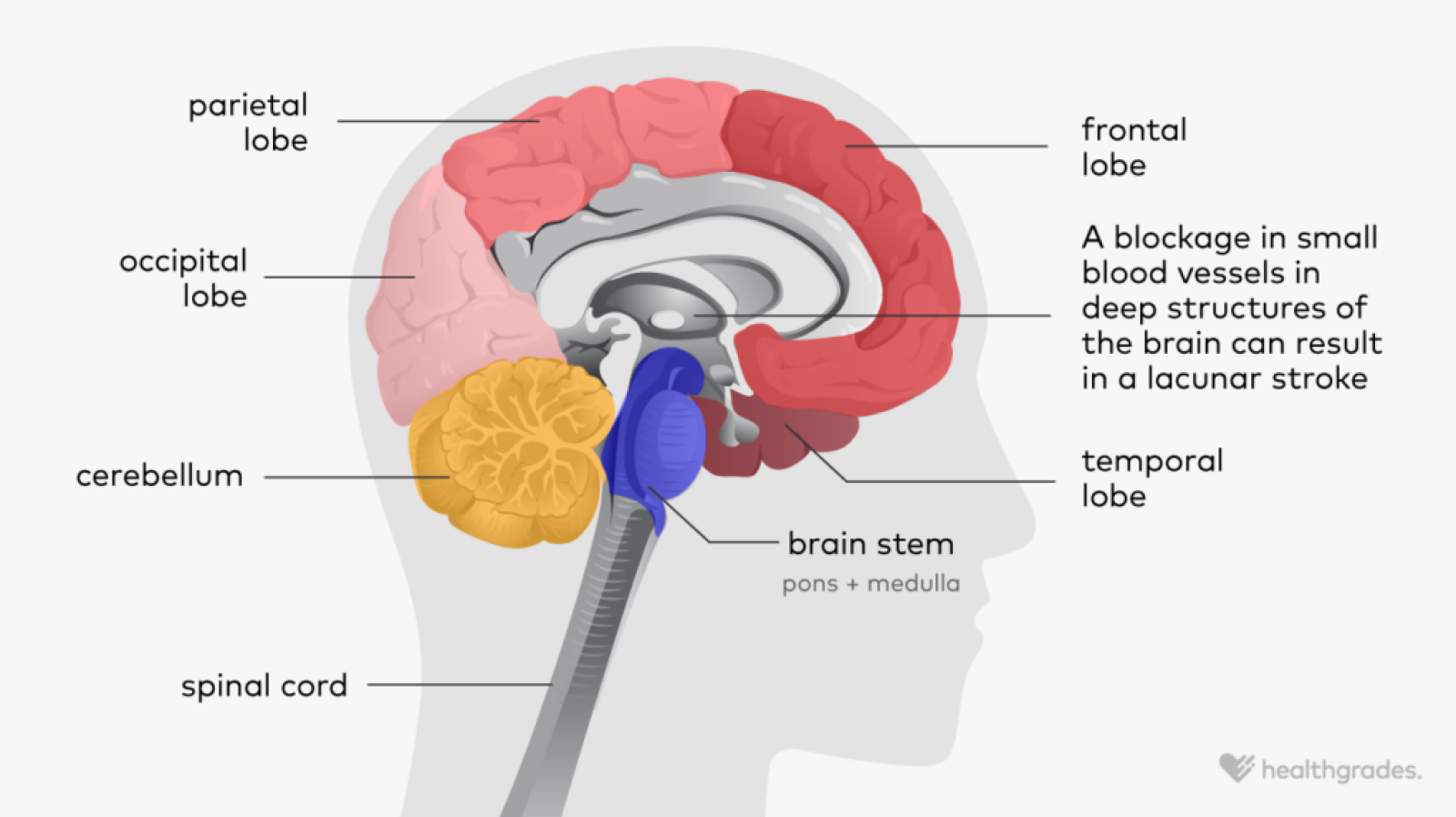 Lacunar Stroke: Symptoms, Causes, Treatments, and More