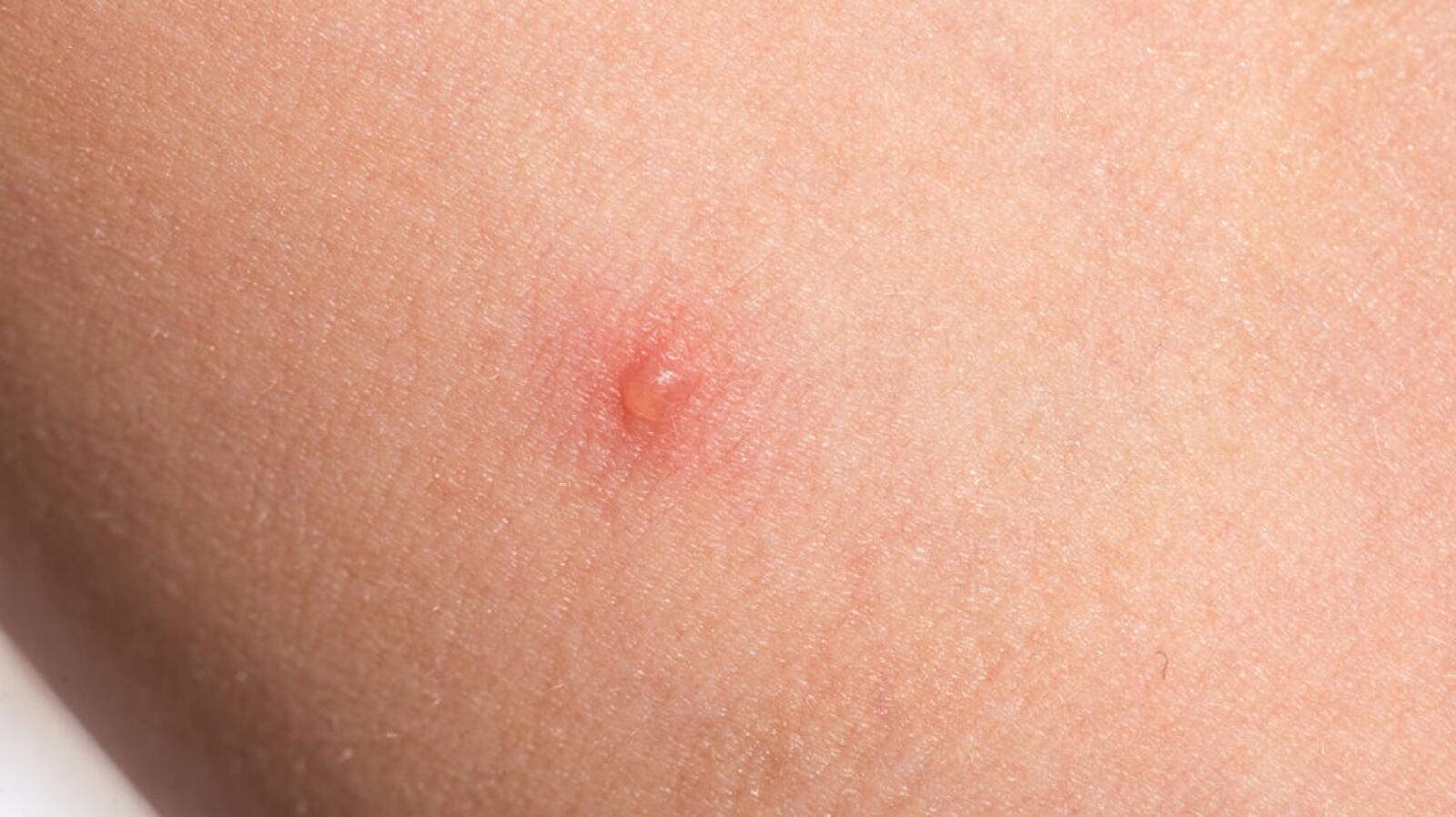 Vesicles Causes and Treatment