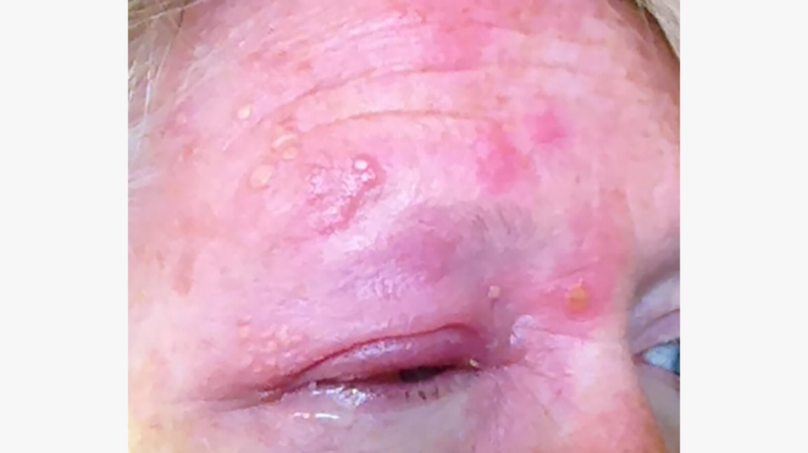 Shingles In the Eye Signs, Treatment, Outlook, and More