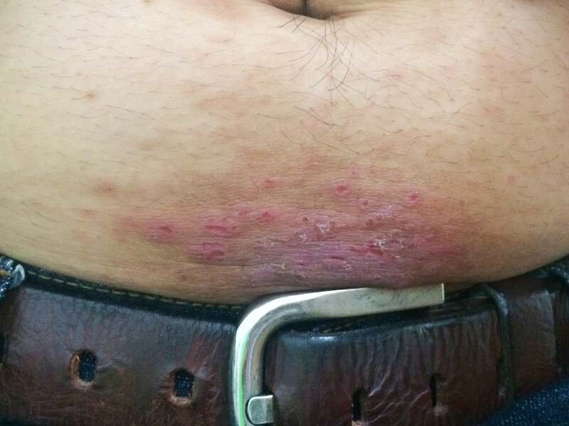 A medical image of contact dermatitis.