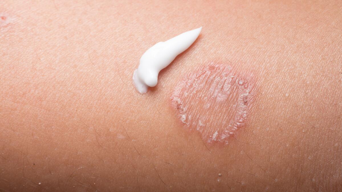 Ringworm (Tinea) Treatment | How to Get Rid of Ringworm Ringworm (tinea) treatment | how to get rid of ringworm