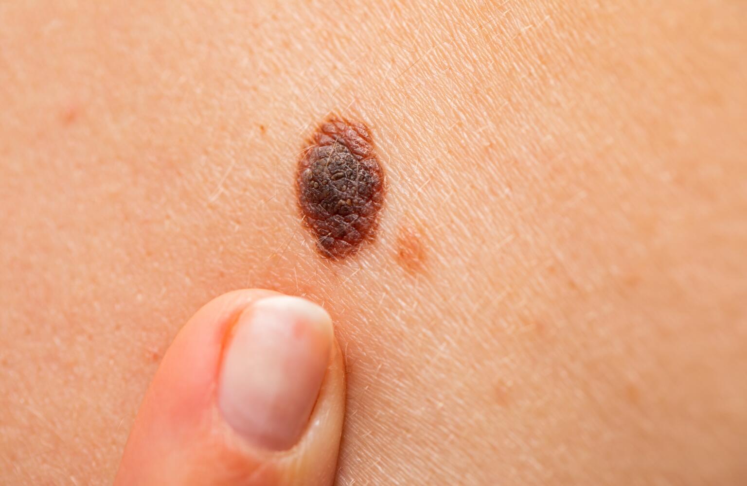 Skin Cancer Symptoms Risk Factors Causes Pictures And Treatments